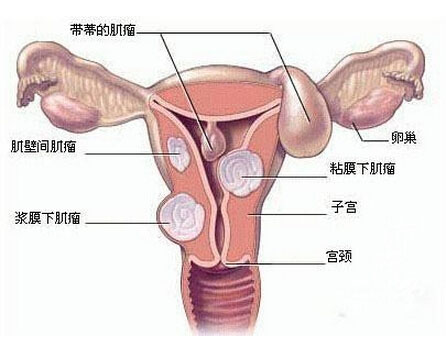 什么原因会造成子宫肌瘤的发生呢